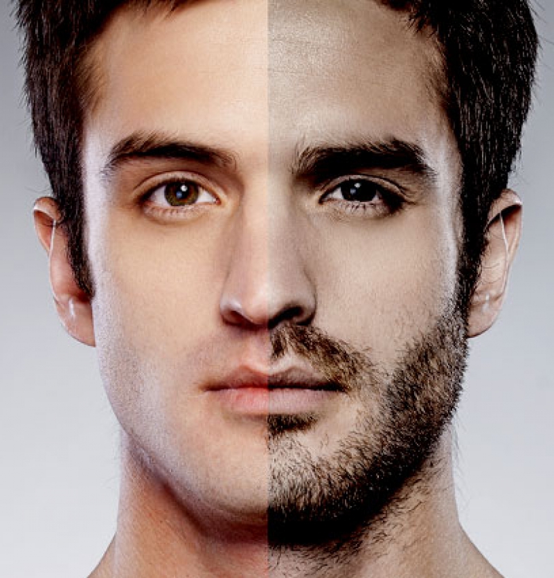 زراعة شعر اللحية