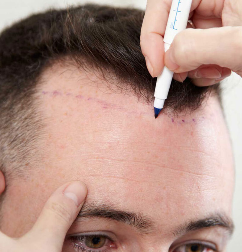 زراعة الشعر في ايران