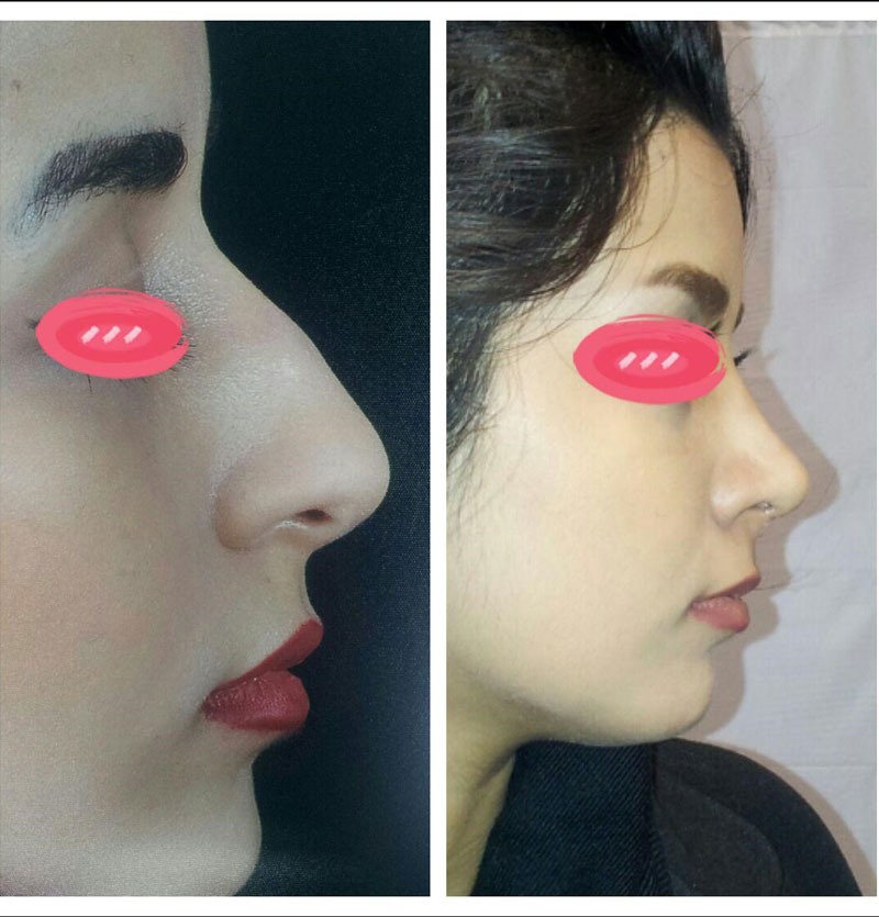 عملية تنحيف و تصغير الأنف في ايران