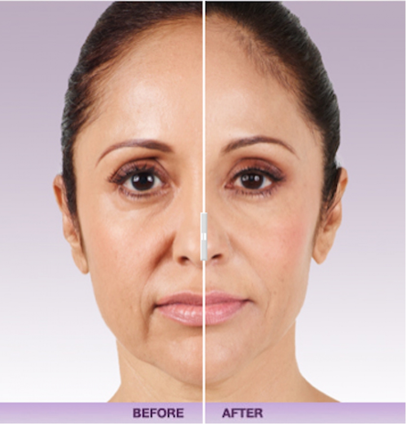 فيلر الخدود