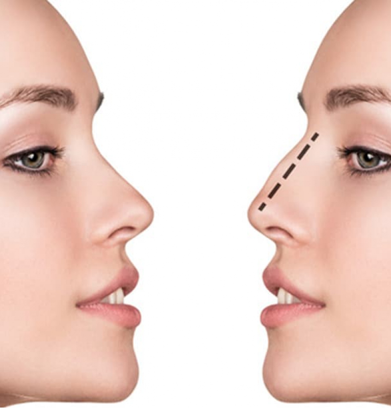 عمليات تجميل الأنف