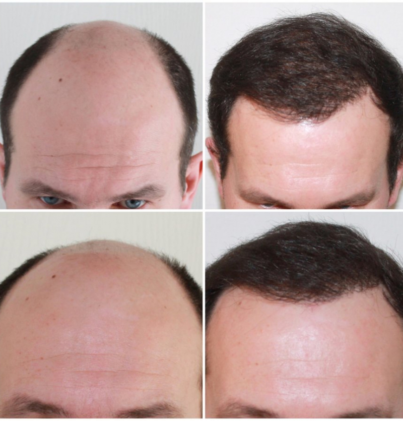 عملية زراعة الشعر وأهم الأسئلة الشائعة عنها